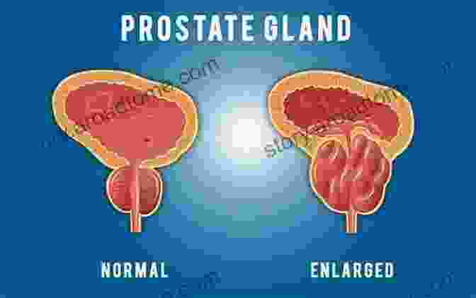 Anatomy Of The Prostate Gland The Prostate And Man S Weaknesses Killers Hidden Behind The Gland That Controls The Physical And Mental Wellbeing Of Males