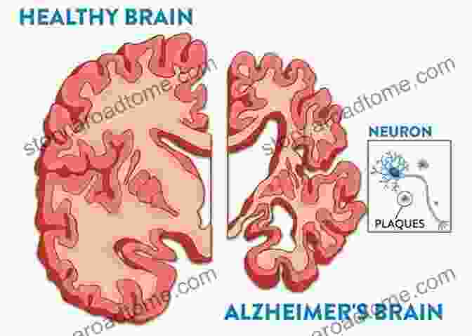 Brain Affected By Alzheimer's Disease Do I Know You?: Touched By Alzheimer S