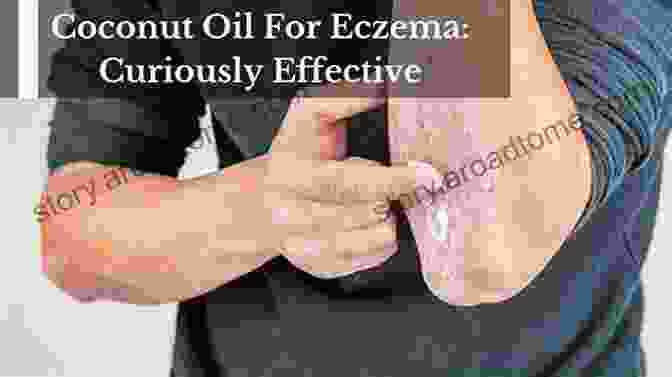 Coconut Oil Application For Eczema Natural Eczema Treatments And Eczema Home Remedies: How To Get Rid Of Eczema For Good Using Effective Natural Eczema Treatments (Natural Remedies For Eczema)