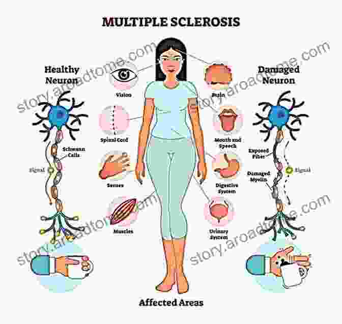 Diagram Of Multiple Sclerosis Multiple Sclerosis Mad Cow Disease And Acinetobacter