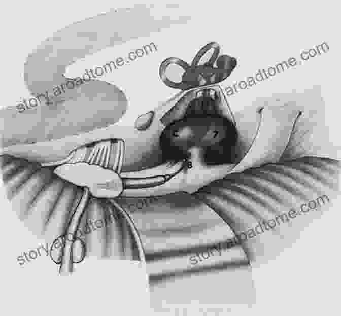 Endoscopic View Of An Acoustic Neuroma During Surgery Endoscopic Ear Surgery: Principles Indications And Techniques