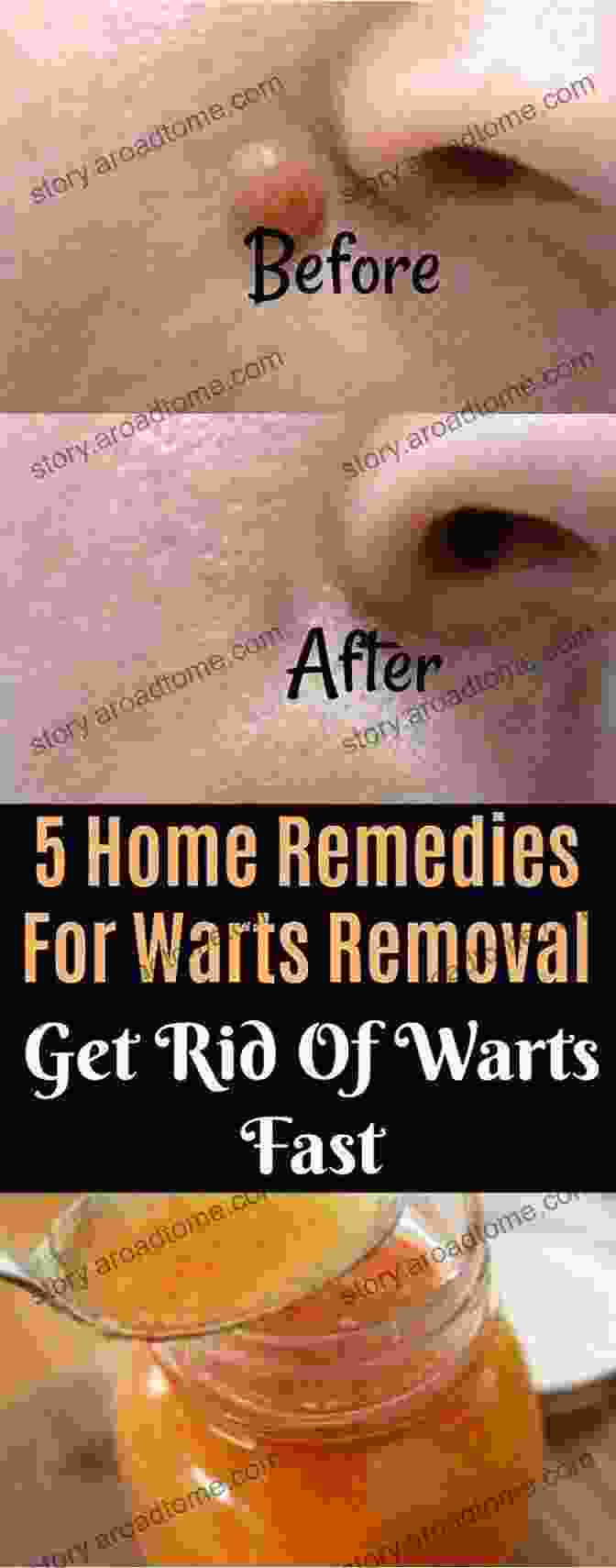 Natural Wart Removal Methods The Wart Cure: How To Get Rid Of Warts Naturally Without Drugs Surgery Or Dangerous Chemicals (Wart Remedies)