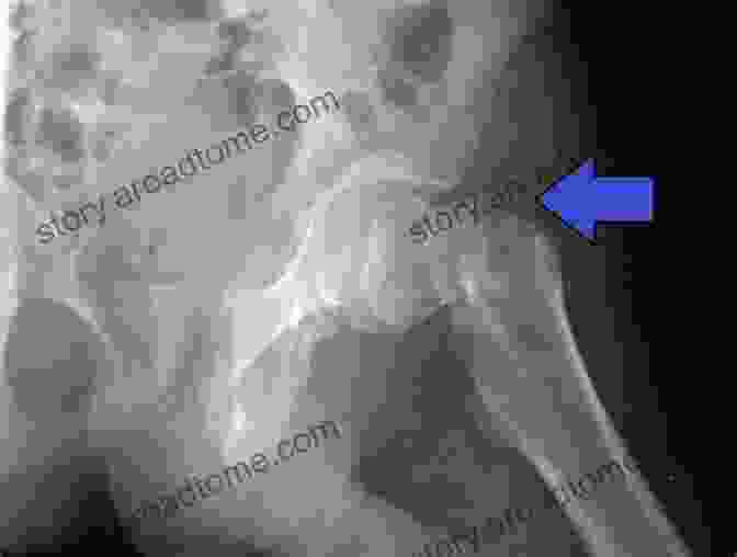 Radiographic Image Of A Hip Joint, Showing A Fractured Neck Of The Femur. Combined Scintigraphic And Radiographic Diagnosis Of Bone And Joint Diseases: Including Gamma Correction Interpretation