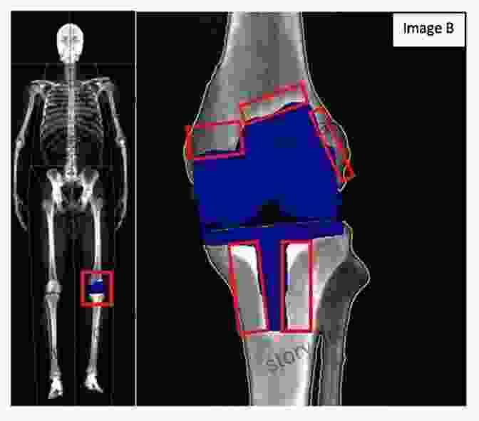 Scintigraphic Image Of A Knee Joint, Highlighting Areas Of Increased Bone Metabolism. Combined Scintigraphic And Radiographic Diagnosis Of Bone And Joint Diseases: Including Gamma Correction Interpretation