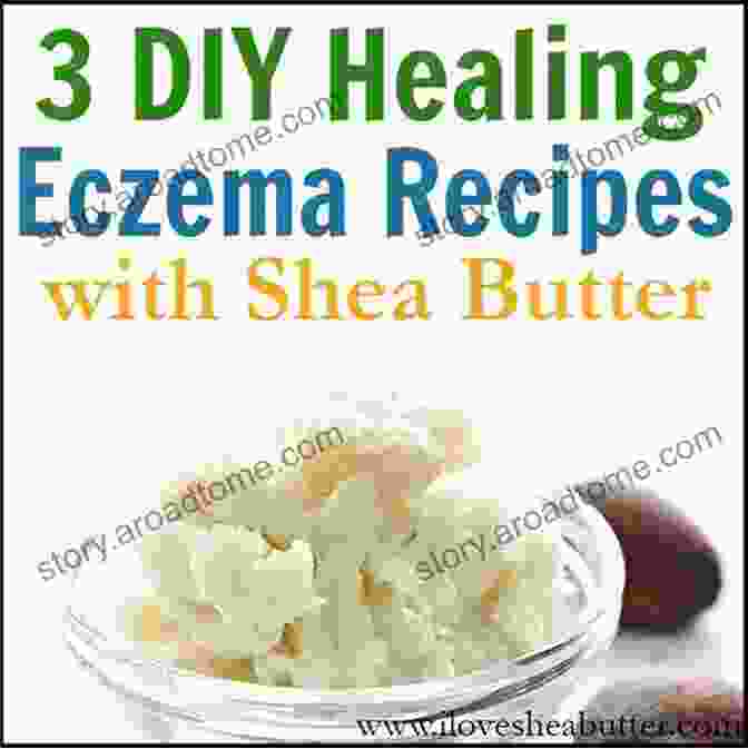 Shea Butter Cream For Eczema On Hands Natural Eczema Treatments And Eczema Home Remedies: How To Get Rid Of Eczema For Good Using Effective Natural Eczema Treatments (Natural Remedies For Eczema)