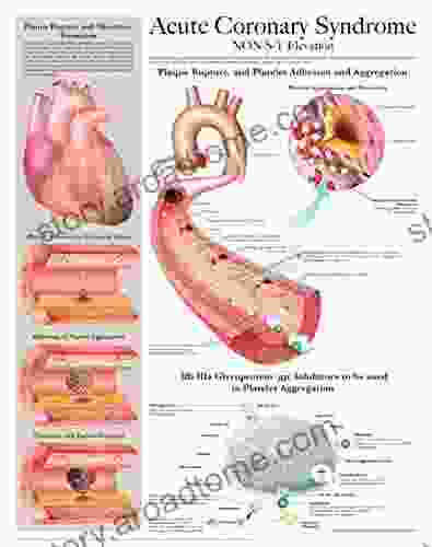 Acute Coronary Syndrome E Chart: Full Illustrated